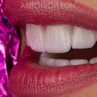 La imagen 3 de la Empresa ANTONIO LEON PERFECCIONAMIENTO DENTAL Odontología cosmética en Cali VAC