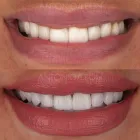 La imagen 5 de la Empresa ANTONIO LEON PERFECCIONAMIENTO DENTAL Odontología cosmética en Cali VAC
