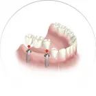 La imagen 3 de la Empresa CLINICA DE IMPLANTES DENTALES DEL SUR Protésico dental en Envigado ANT