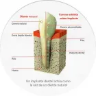 La imagen 5 de la Empresa CLINICA DE IMPLANTES DENTALES DEL SUR Protésico dental en Envigado ANT