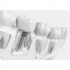 La imagen 1 de la Empresa DENTIPLAN PLUS Periodoncista de implantes dentales en Envigado ANT