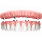 La imagen 2 de la Empresa DENTIPLAN PLUS Periodoncista de implantes dentales en Envigado ANT