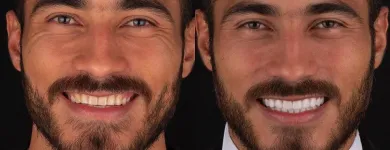 La imagen 4 de la Empresa ANTONIO LEON PERFECCIONAMIENTO DENTAL Odontología cosmética en Cali VAC