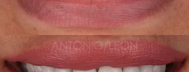 La imagen 5 de la Empresa ANTONIO LEON PERFECCIONAMIENTO DENTAL Odontología cosmética en Cali VAC