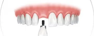 La imagen 1 de la Empresa CLINICA DE IMPLANTES DENTALES DEL SUR Protésico dental en Envigado ANT