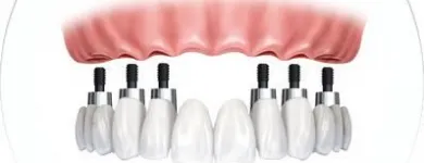 La imagen 2 de la Empresa CLINICA DE IMPLANTES DENTALES DEL SUR Protésico dental en Envigado ANT