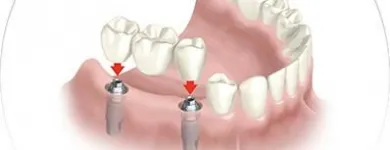 La imagen 3 de la Empresa CLINICA DE IMPLANTES DENTALES DEL SUR Protésico dental en Envigado ANT