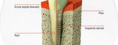 La imagen 5 de la Empresa CLINICA DE IMPLANTES DENTALES DEL SUR Protésico dental en Envigado ANT